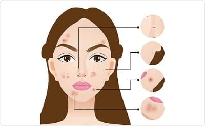 Why do I get Acne? | How does acne form?